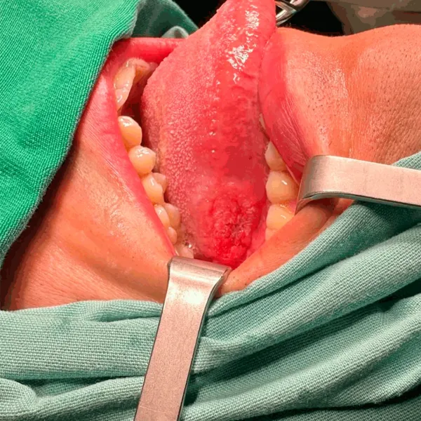 Cirugía de Cavidad Oral