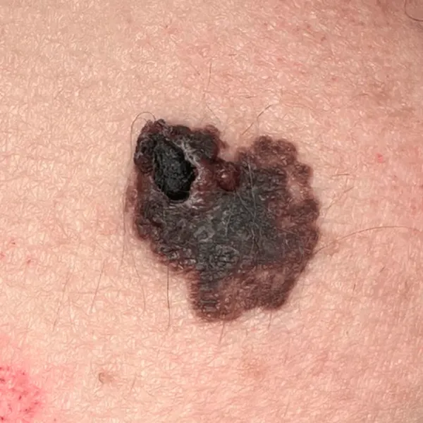 Melanoma y Ganglio Centinela